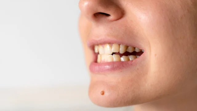 Răng bị lệch khớp cắn có khả năng khiến răng cọ xát vào má gây thương tổn