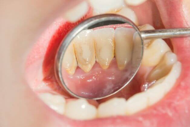 Mảng bám không được làm sạch, tích tụ lâu ngày gây ảnh hưởng cho răng 
