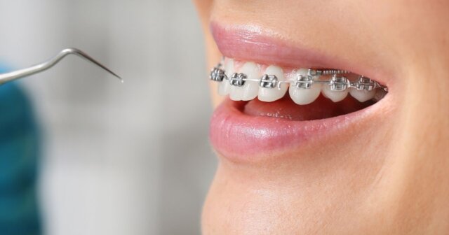 Hướng dẫn cách giảm thiểu tình trạng bung rớt mắc cài