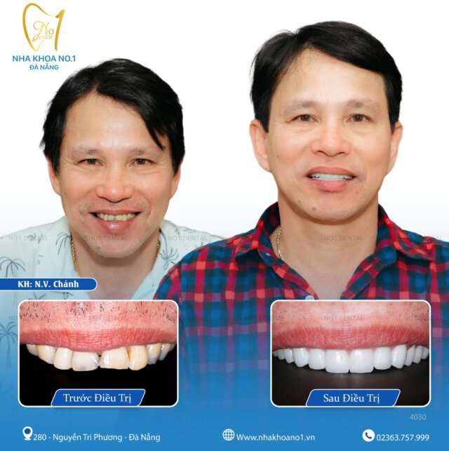 Dù bạn đang ở độ tuổi nào, chỉ cần muốn, Nha khoa No1 Đà Nẵng luôn sẵn sàng đồng hành cùng bạn để mang lại nụ cười hoàn hảo nhất!