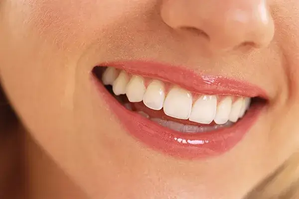 Làm thế nào để sở hữu nụ cười như mong muốn?
