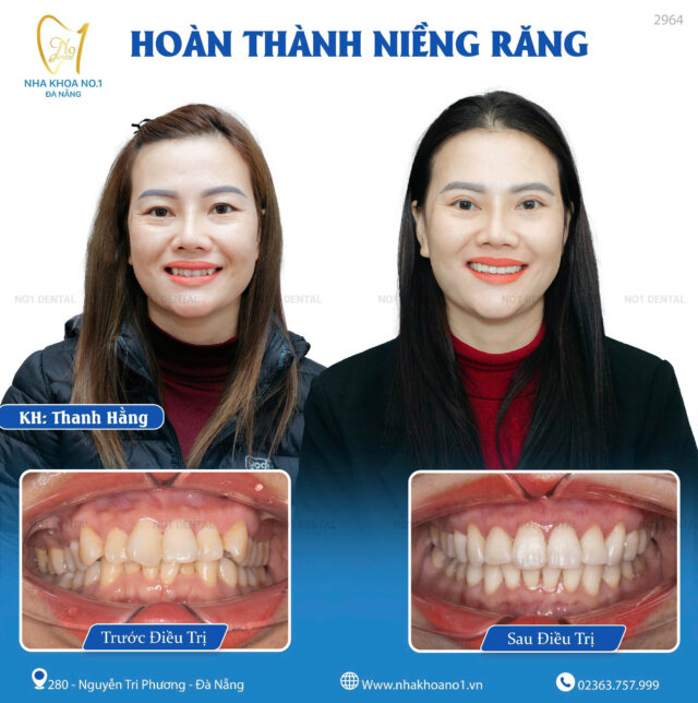 Hàng ngàn khách hàng đang đeo niềng và tháo niềng thành công hàng trăm ca khó tại Nha khoa No1