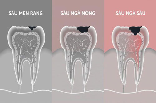Nếu không được phát hiện và điều trị sớm, sâu răng có thể chuyển biến sang các giai đoạn nặng hơn