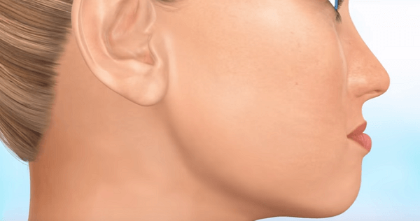 Lý do khiến răng bị móm sau khi niềng là gì?