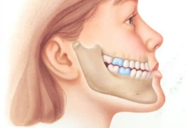 Giải pháp khắc phục tình trạng móm sau khi niềng răng