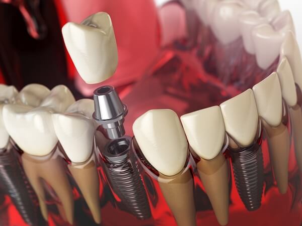trong-rang-implant-co-dau-khong-1