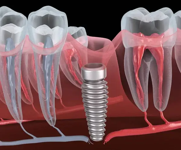 Cảm giác khó chịu sau khi trồng Implant sẽ giảm sau bao nhiêu ngày?