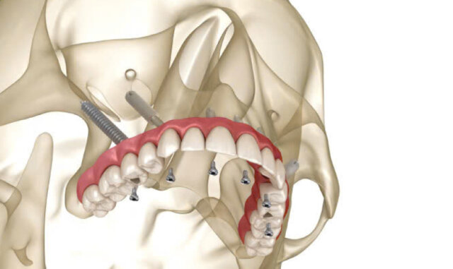 Quy trình cấy Implant xương bướm đòi hỏi bác sĩ có kinh nghiệm và chuyên môn cao