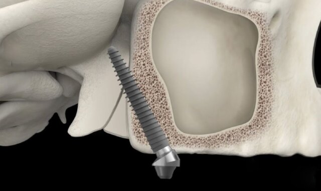 Ưu điểm của Implant xương bướm
