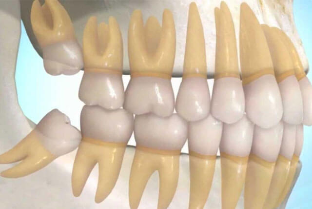 Thông tin cơ bản về răng hàm là gì