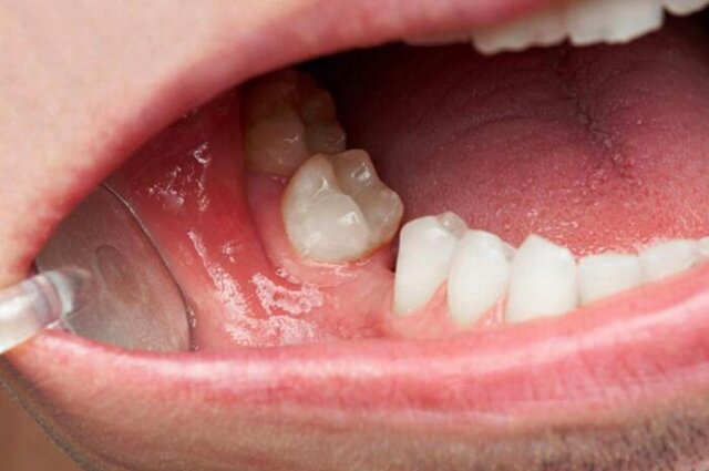 Mất vị trí răng hàm có khả năng làm hóp má không?