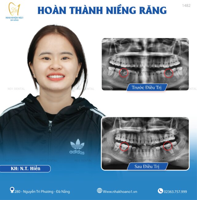 Ca niềng thành công khắc phục mất răng số 6 tại Nha khoa No1